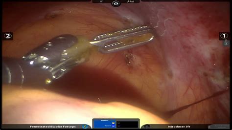 Robotic Ovarian Cyst Draining Youtube