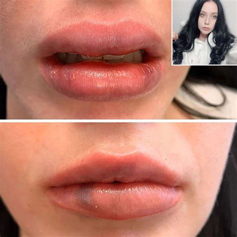 deavan clegg reveals her lip was dying after botched injections