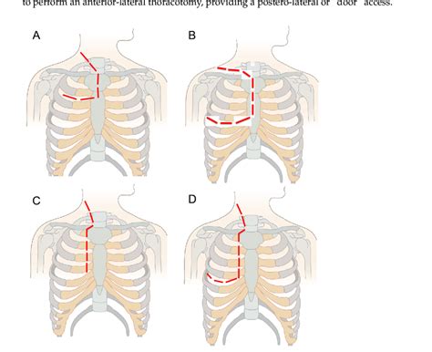 Main Surgical Approaches For The Resection Of Cervicothoracic Nbs The