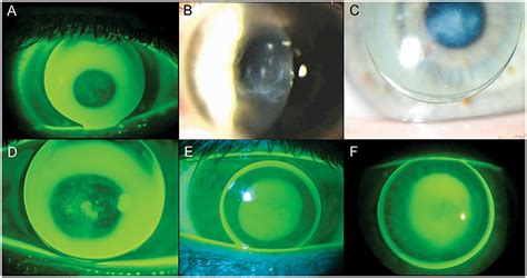 Contact Lens Management Of Keratoconus Downie 2015 Clinical And