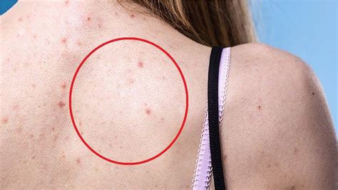 How To Get Rid Of Bacne And Shoulder Acne Youtube