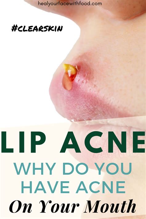 Lip Acne Why Do You Have Acne On Your Mouth Heal Your Face With