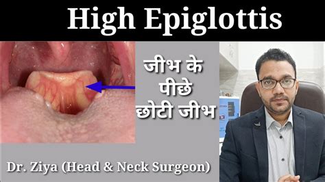Leaf Like Structure In Throat High Epiglottis Epiglottis Visible In