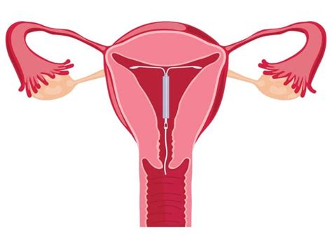 Things You Should Know About Iud Pregnancy Organic Facts