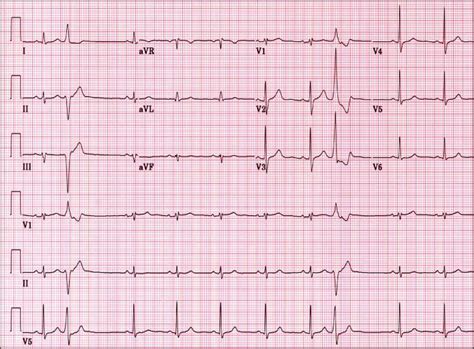 EKG - Diabetes & Endocrinology Specialists
