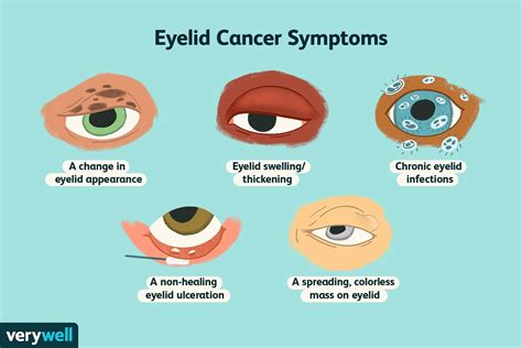 Eyelid Cancer Overview And More