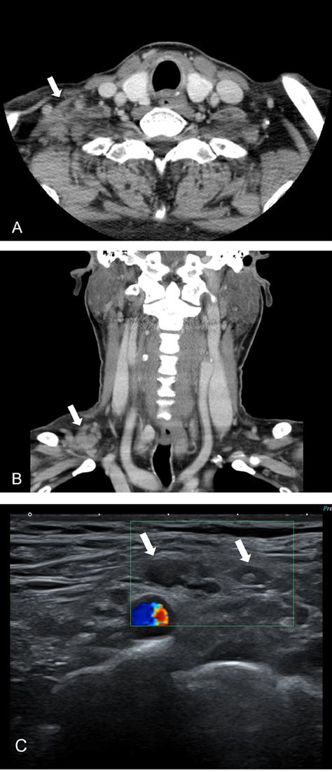 Rare Case Of Contralateral Supraclavicular Lymphadenopathy After Covid