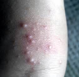 Rash On Back Of Knees Pictures Photos