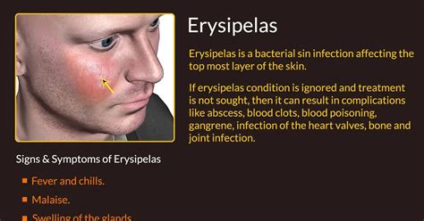 Erysipelas Face Treatment Doctor Heck