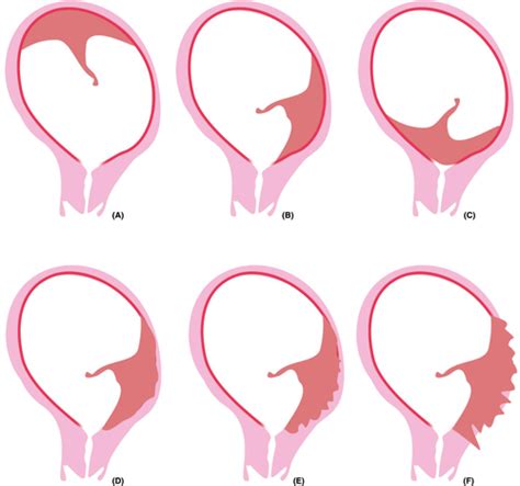 Development Of Placental Abnormalities In Location And Anatomy Jansen