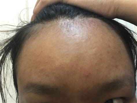 Small Bumps On Forehead General Acne Discussion By A L Acne Org Community