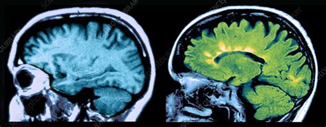Mri Of Normal Brain And Ms Lesions Stock Image C0272385 Science