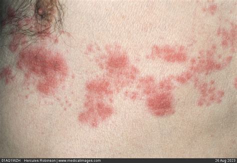 Stock Image Infectious Diseases Shingles Herpes Zoster Multiple