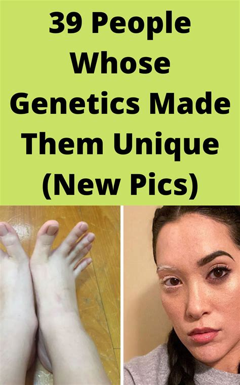 39 People Whose Genetics Made Them Unique New Pics In 2020 Genetics