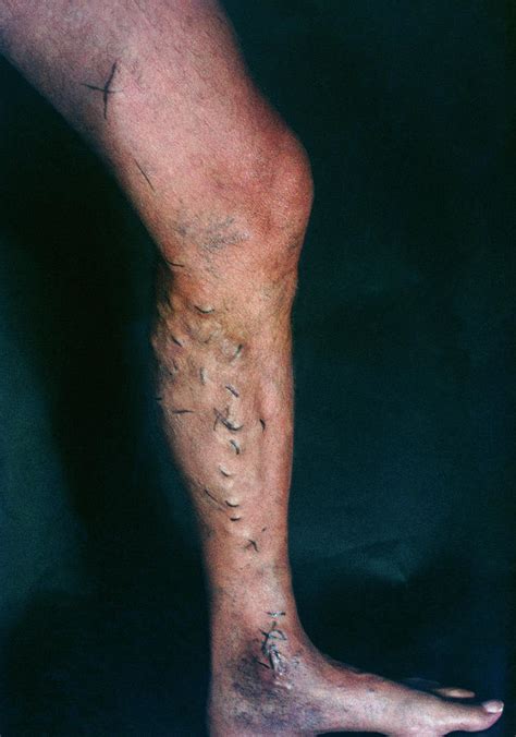 Varicose Veins Photograph By Medimagescience Photo Library Pixels