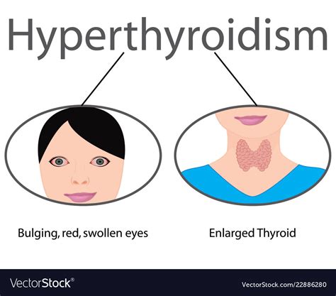 Hyperthyroidism Graves Disease Royalty Free Illustration The Best