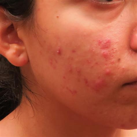 Dr Pimple Popper Reveals The Acne You Shouldn T Pop Reader S Digest