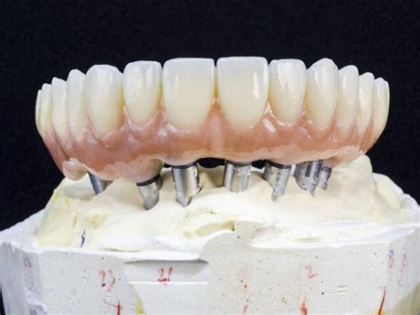 Dental Implants Cost Full Mouth Restoration Dr Gibberman