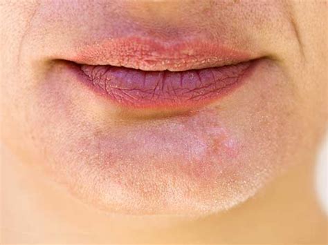 A vitamin deficiency can wreak havoc on your skin, hair, nails, and more. How Your Face Reflects Vitamin Deficiencies - Boldsky.com