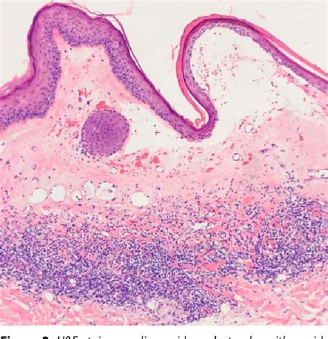 Figure 3 From Bullous Hemorrhagic Lichen Sclerosus Of The Breast A
