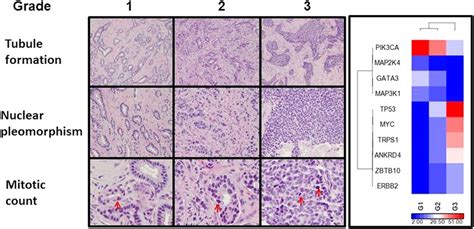 Invasive Ductal Carcinoma Of Various Nottingham Histological Grades
