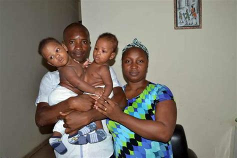Nigerian Conjoined Twins Finally Gets Separated After Successful