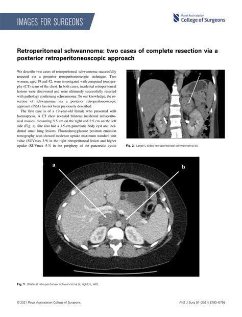 Pdf Retroperitoneal Schwannoma Two Cases Of Complete Resection Via A