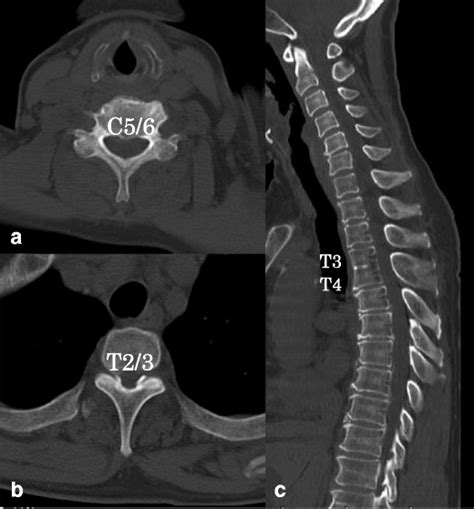 Preoperative Plain Ct Images Of Thoracic Spine Axial Images Showed