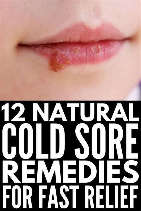 fast and effective 12 natural cold sore remedies that work natural cold sore remedy cold