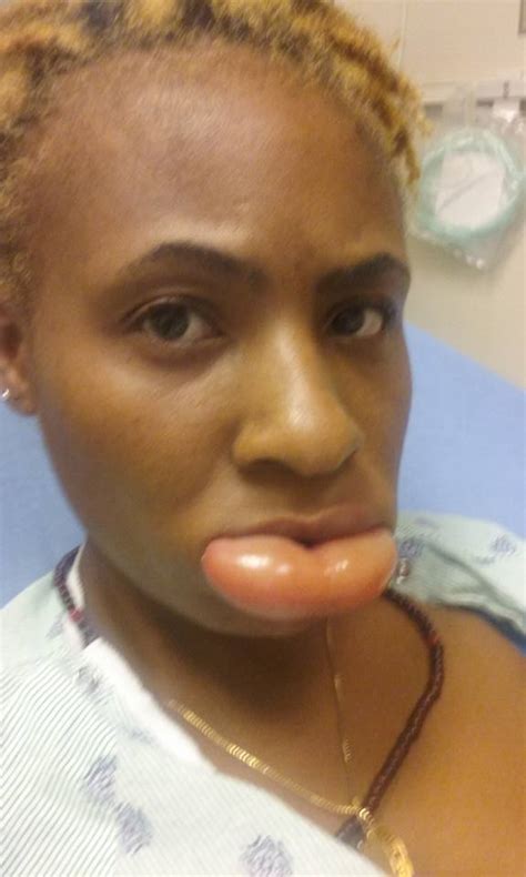 Woman Gets With Swollen Lips After Using A Dubious Lipstick Before And