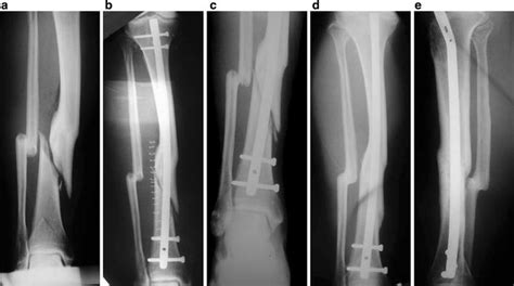 Closed Tibial Fracture At The Site Of A Previous Malunion In A