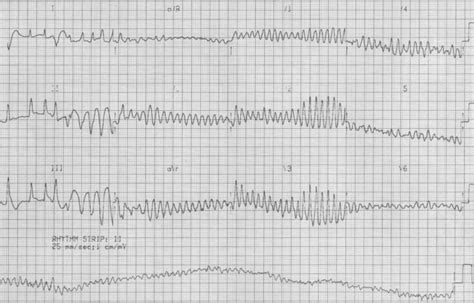 Sudden Syncope At Soccer • Litfl • Clinical Cases Ecg Exigency