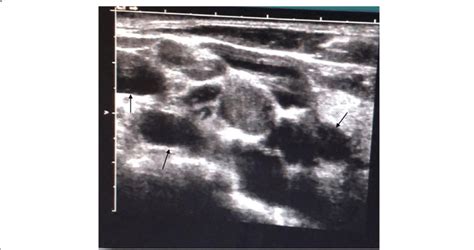 Ultrasound Indicated Multiple Lymph Node Enlargement In Bilateral