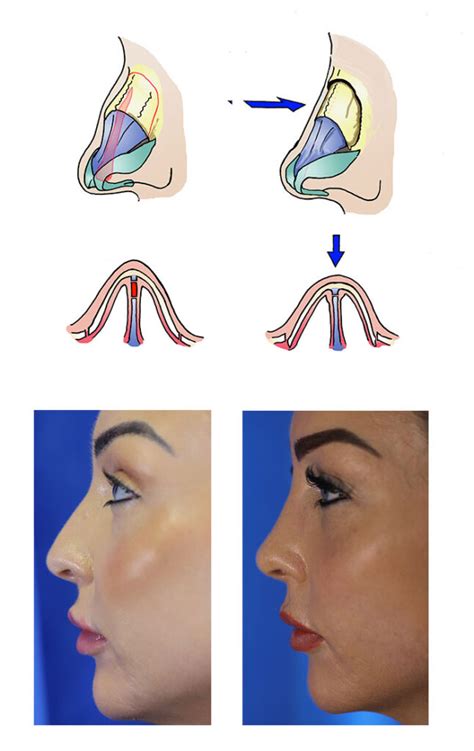 Rhinoplasty Nose Job Surgery Procedure