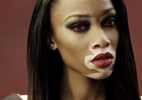 Chantelle Vitiligo Model Beauty Shoot Vitiligo