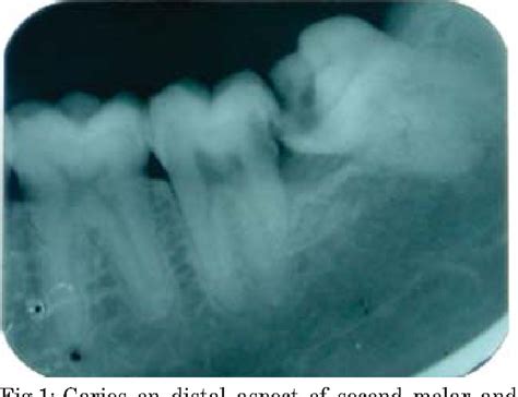 Figure 4 From Incidence Of Distal Caries In Mandibular Second Molars