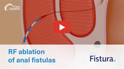 Rfa Of Anal Fistulas Fistura® F Care Systems F Care Systems