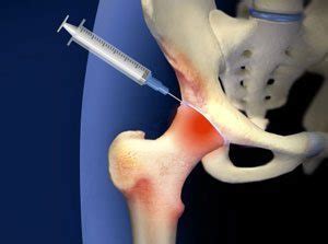 Structural hip disorders hip dysplasia and hip impingement (doctors call it femoroacetabular hip joint injections: Platelet Rich Plasma (PRP) Injection Treatment for Hip ...