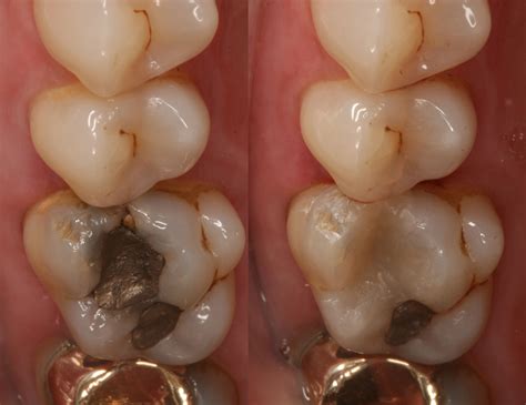 Types of Dental Fillings - Eagle Harbor Dentist