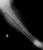 Dripping Candle Wax Sign Melorheostosis Radiology Reference Article Radiopaedia Org
