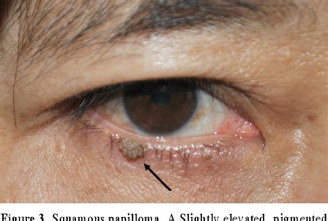 Figure 7 From Clinical Characteristics Of Benign Eyelid Tumors