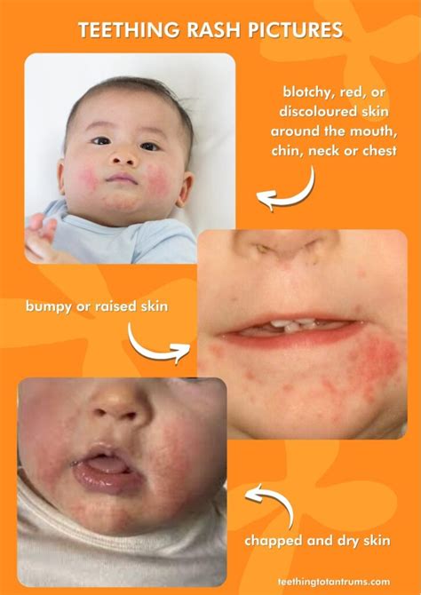 Teething Rash Causes Symptoms Pictures 7 Top Treatments