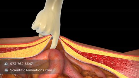 A hernia happens when an organ or fatty tissue squeezes through a weak spot in the abdominal muscles or connective tissue (see figure 1). Inguinal Hernia Mesh - 3D Medical Animation - YouTube