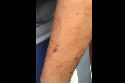 Derm Dx Dark Spots On The Arms Dermatology Advisor