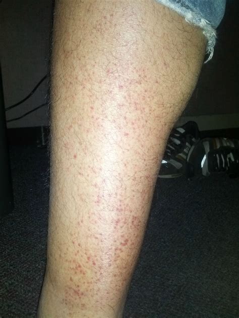 Red Dots On Legs Little Red Spots On Legs Pic Babycenter Themes Of Love