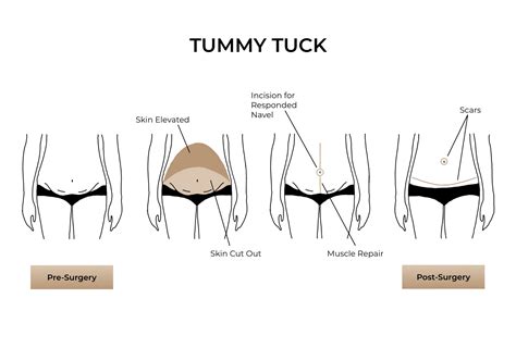 Tummy Tuck Surgery Abdominoplasty Enhance Medical