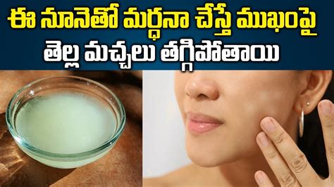 How To Remove White Spots On Face Permanently Skin Care Tips
