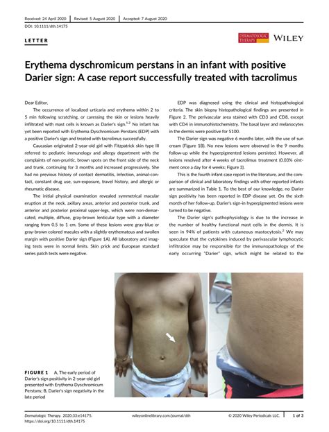 Erythema Dyschromicum Perstans In An Infant With Positive Darier Sign