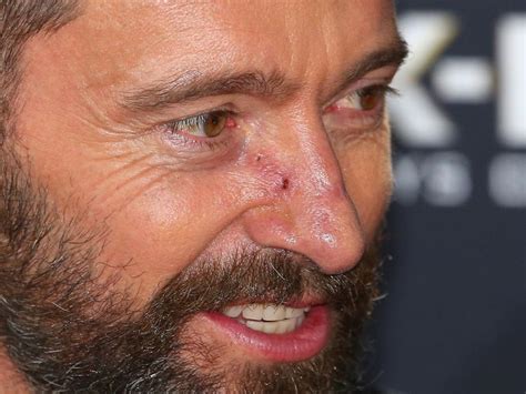 Actor Hugh Jackman Has Sixth Skin Cancer Removed From His Nose