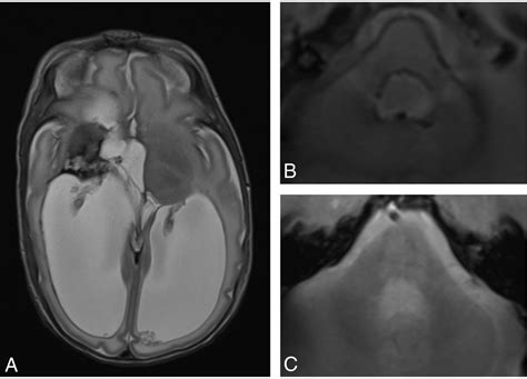 Superficial Siderosis After Germinal Matrix Hemorrhage American